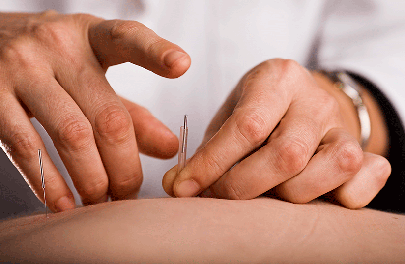 Practitioner placing acupuncture needles